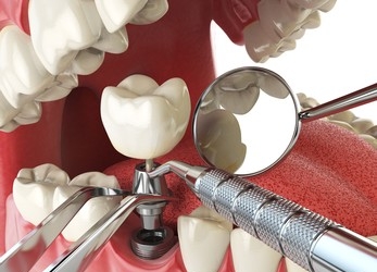 How Is the Dental Implant Procedure Done in Antalya Turkey?
